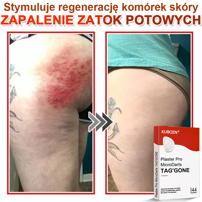 KUBOZN® Mikroigłowy Botaniczny Plaster na Usuwanie Brodawek Skórnych✨✨✨