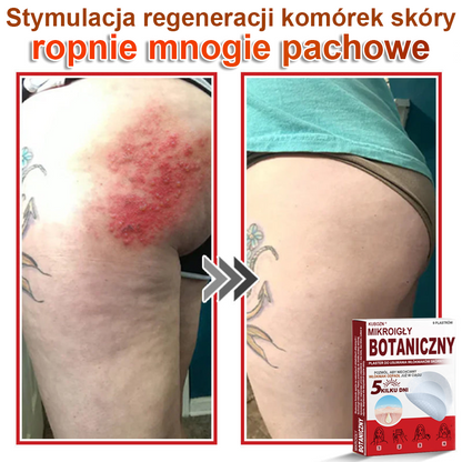 KUBOZN® Mikroigłowy botaniczny środek do usuwania narośli skórnych ✅✅✅wyprodukowano w Polsce✅