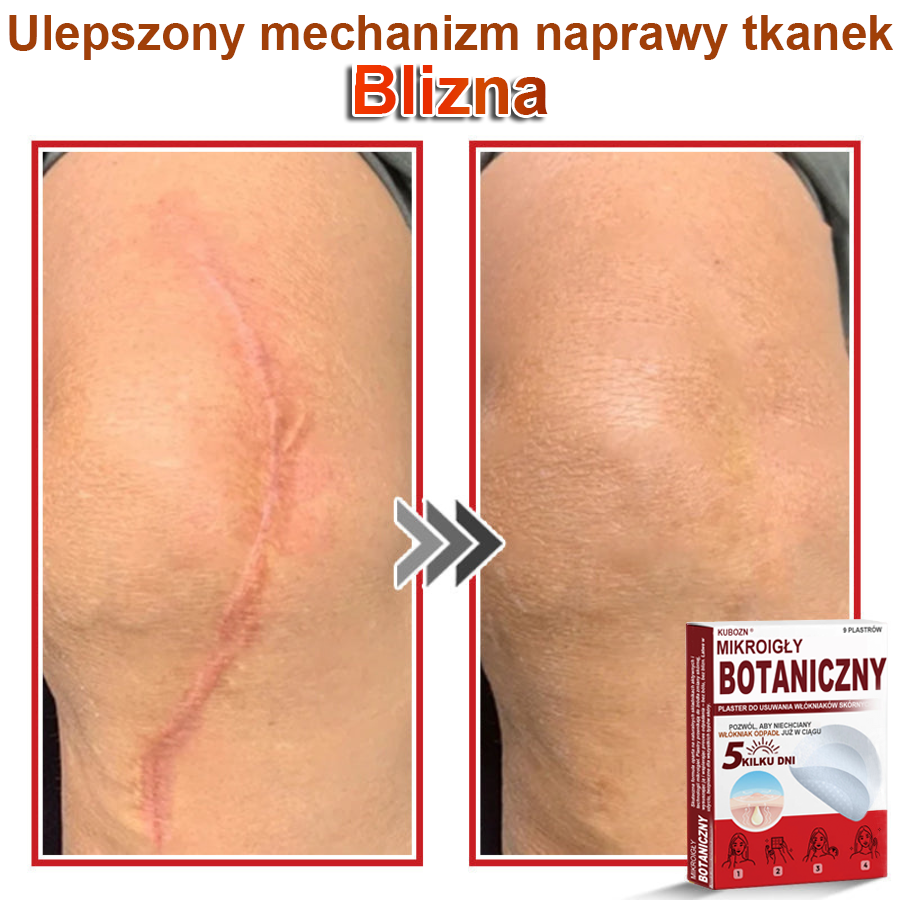 KUBOZN® Mikroigłowy botaniczny środek do usuwania narośli skórnych ✅✅✅wyprodukowano w Polsce✅