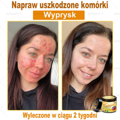 ΑPΚΑPK™ Jad Pszczoły Kompleksowy Krem🥇🥇pomaga w leczeniu problemów skórnych, takich jak: zmarszczki, blizny, plamy pigmentacyjne, rozstępy, trądzik, łuszczyca, egzema, zmiany skórne, podrażnienia, stany zapalne i inne problemy skórne🔥🔥🔥