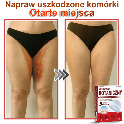 KUBOZN® Mikroigłowy botaniczny środek do usuwania narośli skórnych ✅✅✅wyprodukowano w Polsce✅