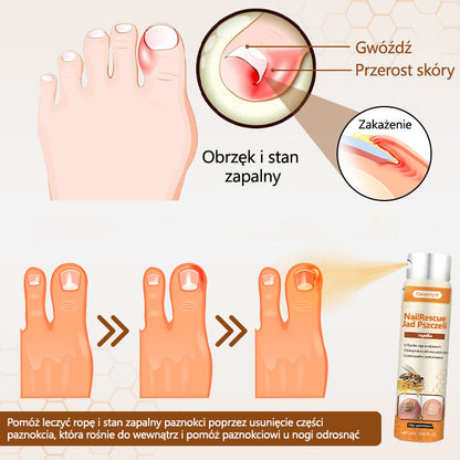 Spray z jadem pszczelim – skuteczny w leczeniu infekcji grzybiczych i zapalenia paznokci🎁