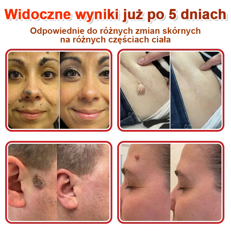 KUBOZN® Mikroigłowy Botaniczny Plaster na Usuwanie Brodawek Skórnych✨✨✨