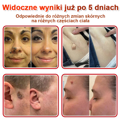 KUBOZN® Mikroigłowy Botaniczny Plaster na Usuwanie Brodawek Skórnych✨✨✨