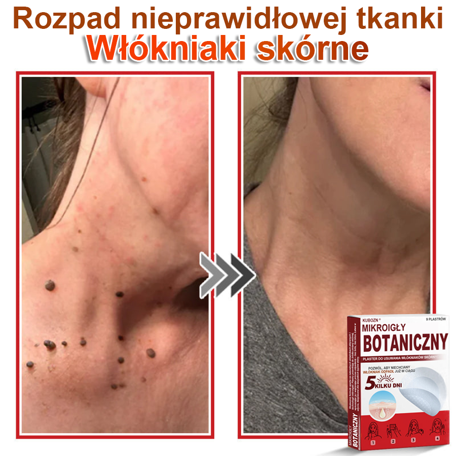 KUBOZN® Mikroigłowy botaniczny środek do usuwania narośli skórnych ✅✅✅wyprodukowano w Polsce✅