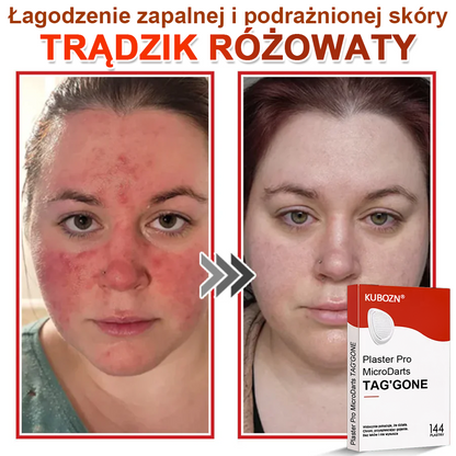 KUBOZN® Mikroigłowy Botaniczny Plaster na Usuwanie Brodawek Skórnych✨✨✨