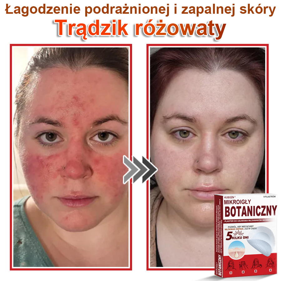 KUBOZN® Mikroigłowy botaniczny środek do usuwania narośli skórnych ✅✅✅wyprodukowano w Polsce✅
