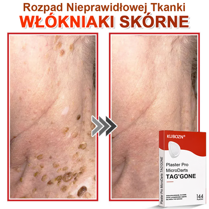 KUBOZN® Mikroigłowy Botaniczny Plaster na Usuwanie Brodawek Skórnych✨✨✨