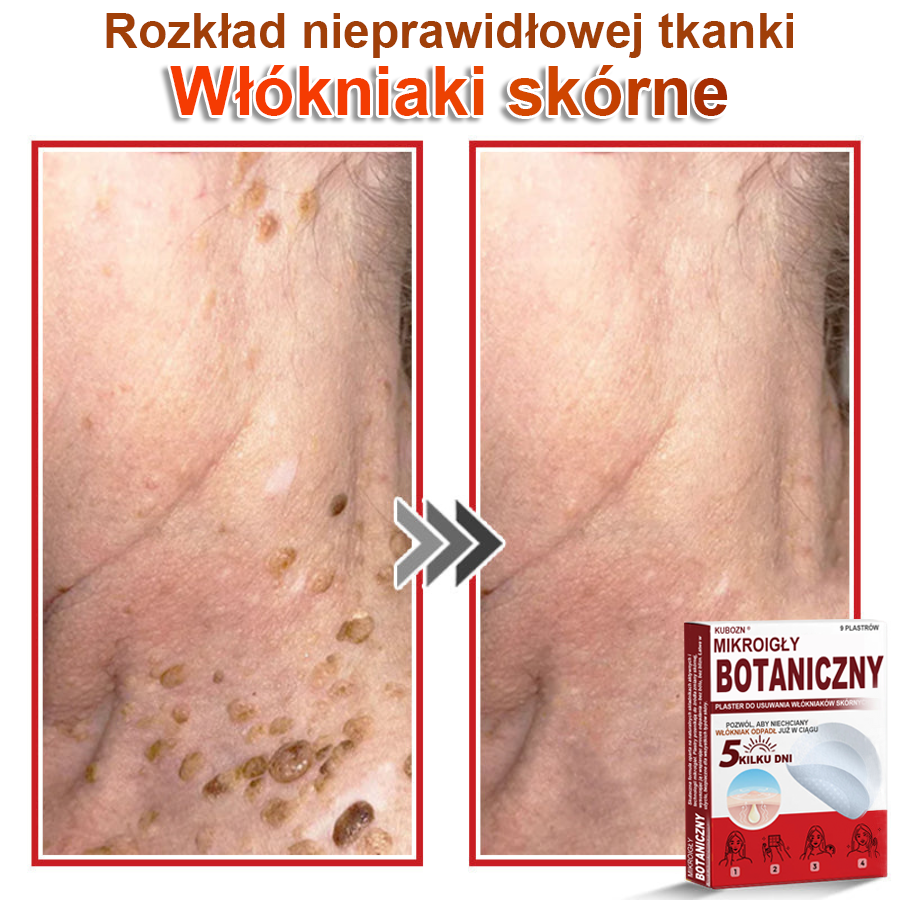 KUBOZN® Mikroigłowy botaniczny środek do usuwania narośli skórnych ✅✅✅wyprodukowano w Polsce✅