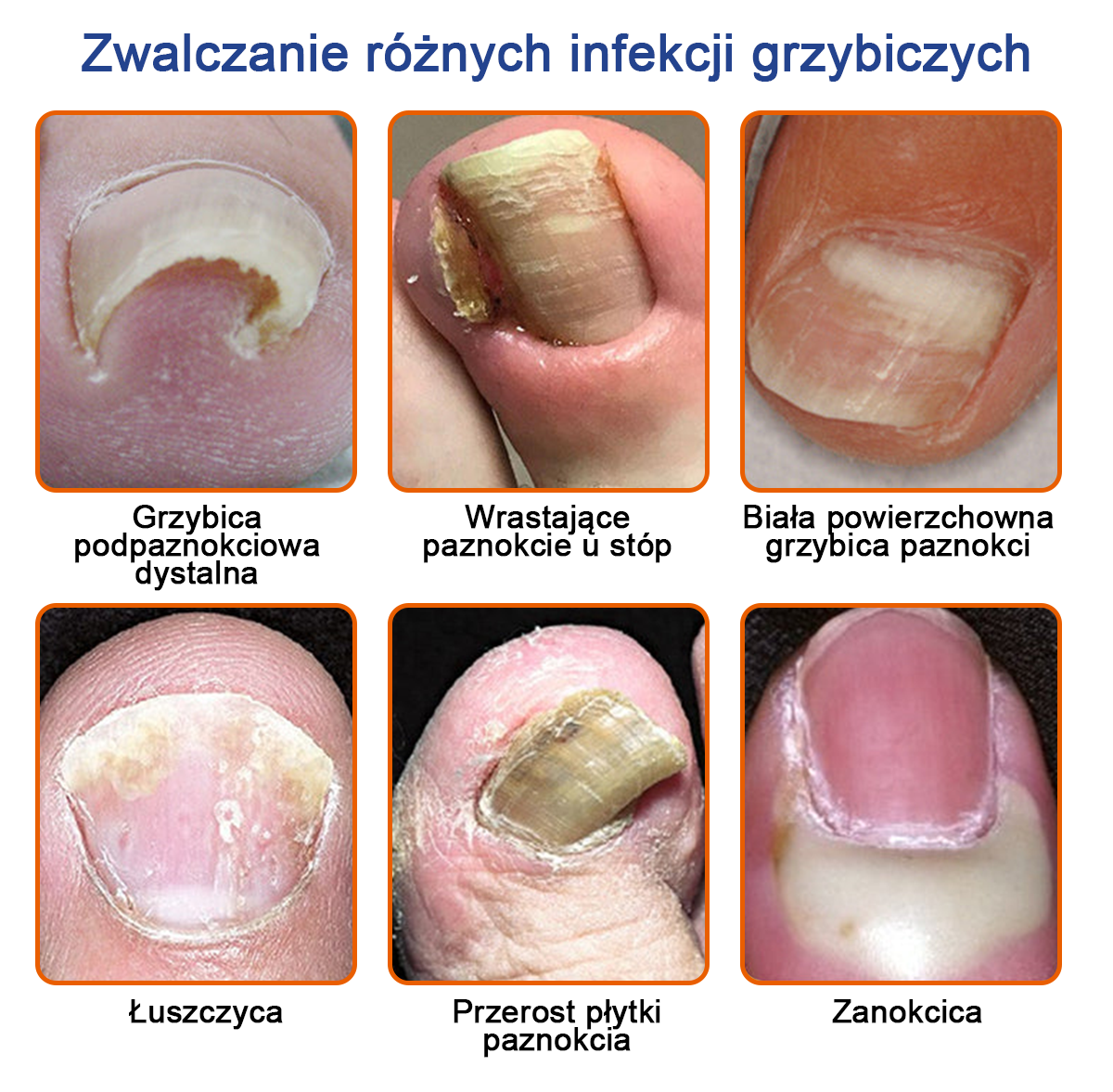🐝🐝Furzero™ Bienengift Nagelpilz Leczenie: Całkowite rozwiązanie problemu grzybicy paznokci🌟👣👣👣