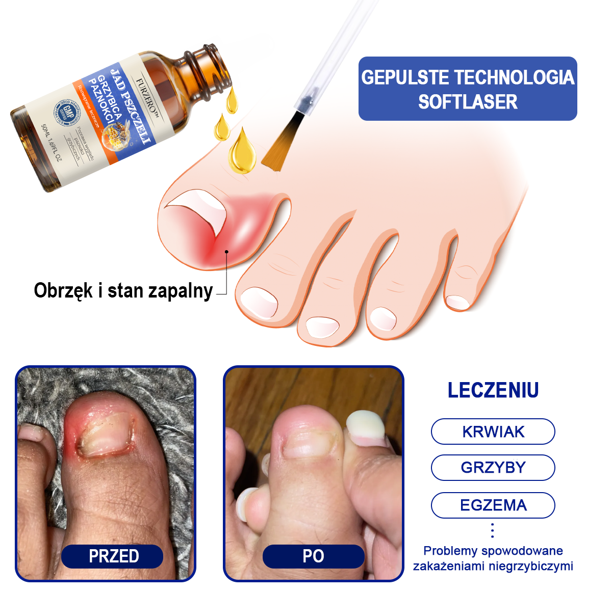 🐝🐝Furzero™ Bienengift Nagelpilz Leczenie: Całkowite rozwiązanie problemu grzybicy paznokci🌟👣👣👣
